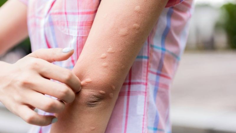 Nên chăm sóc vết muỗi đốt ở trẻ như thế nào?