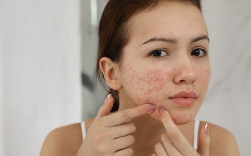 Nên làm gì để mụn không xuất hiện nữa sau khi nặn
