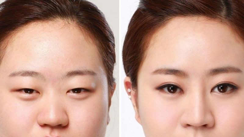 Trước khi cắt mí kiêng ăn gì?